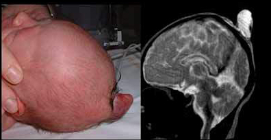 41-encephalocele-du-vertex