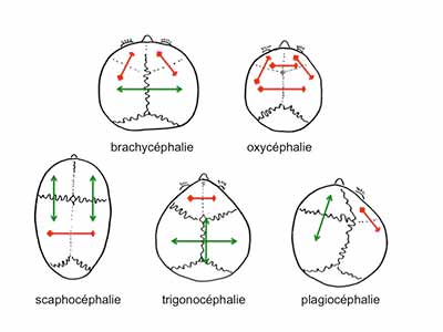 6-craniostenoses-loi-de-Virchow