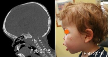 achondroplasie distraction