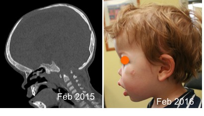 achondroplasie distraction