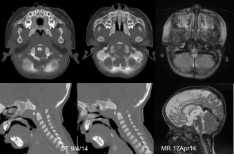 achondroplasie postop