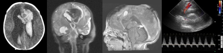 anévrysme mycotique