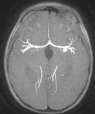 anévrysme non rompu