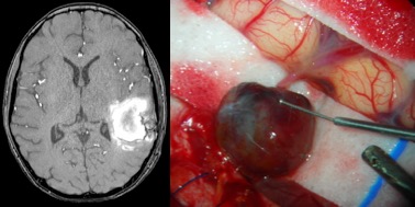 anévrysme traumatique