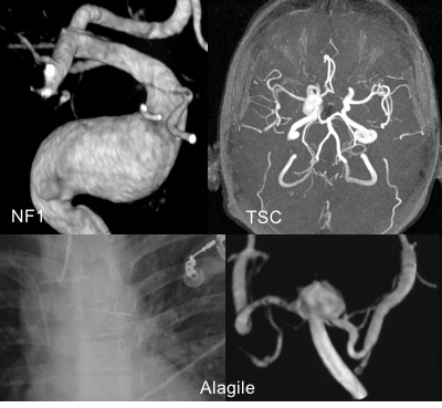 anévrysmes syndromiques