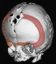 brachy craniectomie