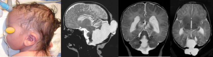 Chiari 3 Ait Boubouh