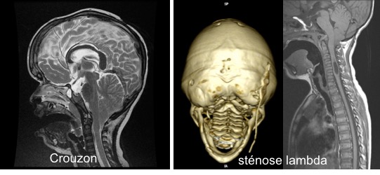 Chiari craniosténoses