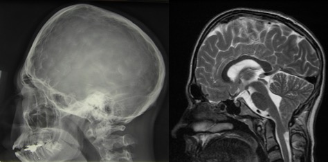 Chiari hypophosphatasie