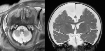 DAN kystes polykystose