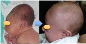 déformation anténatale