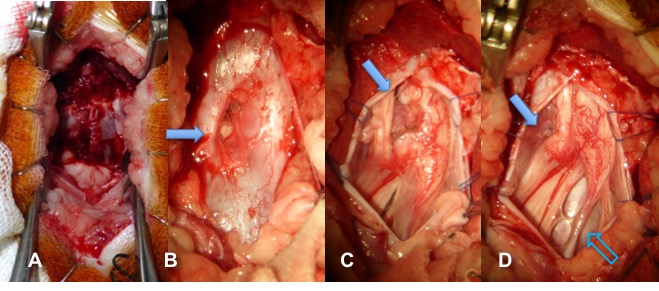 diastématomyélie BO