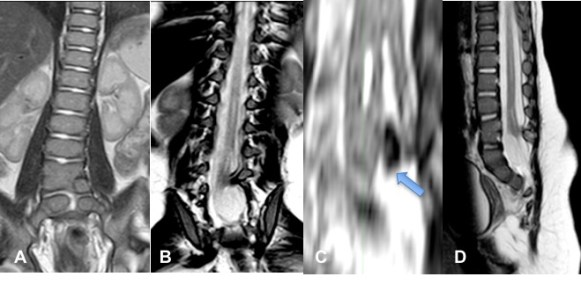 diastématomyélie imagerie