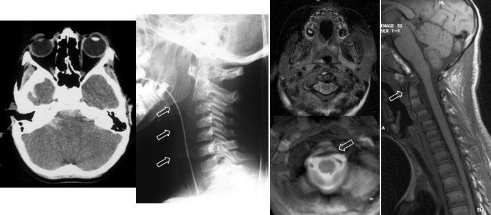 dislocation C0C1 bis