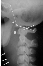 dislocation C0C1 Power's