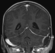 empyème ED mastoïdite