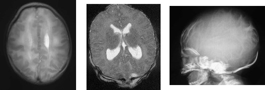 encephalocele O hydro