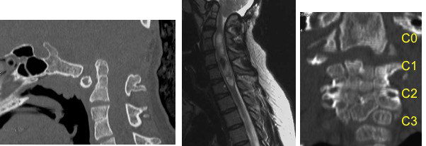 encephalocele O Klippel Feil
