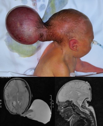 encephalocele O