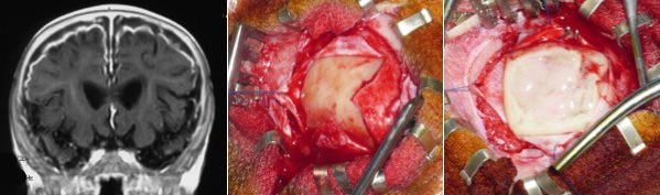 HSD post-M craniotomie
