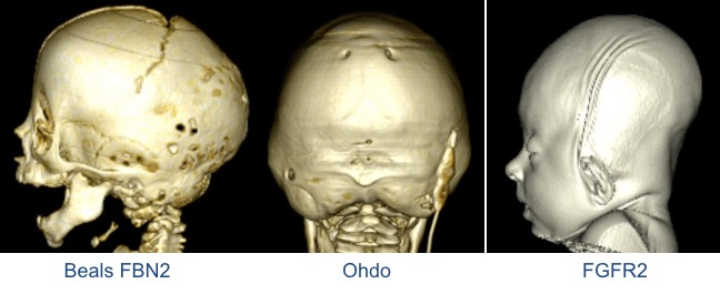 lambdoïde syndromique