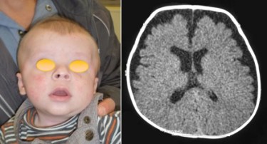 macrocéph cortic eczema