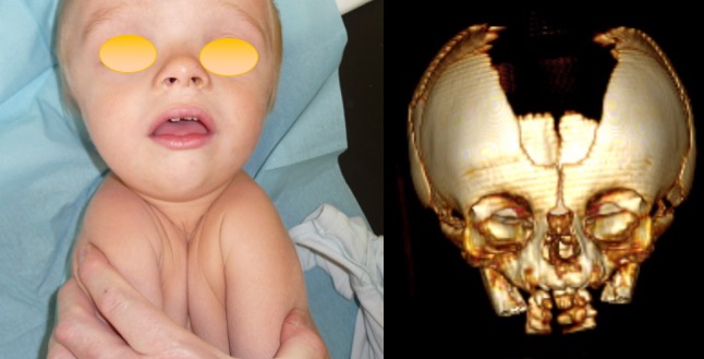 macrocéph dysostose cléïdo-crânienne