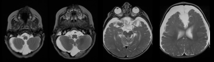 macrocéph polykystose