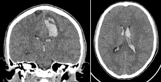 MAV non rompue saignement