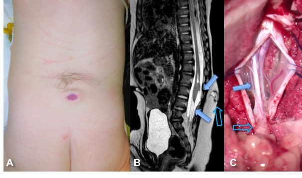 méningocèle manquée bis