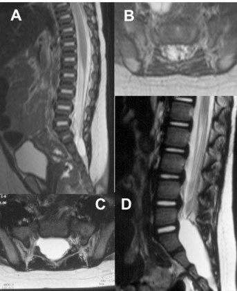 méningocèle Tarlov