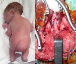 myélocystocèle terminale