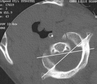 physio laxité rotation