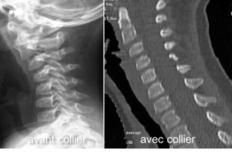 physio laxité slide
