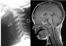 rachis # sous-chondrale
