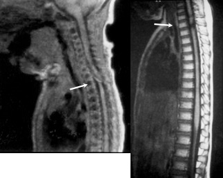 SCIWORA obstétrical
