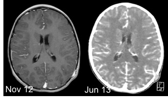 sinus pericranii thrombose