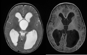 supra-sellaire hydro