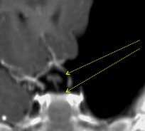 sylvien fenestration
