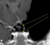 sylvien fenestration
