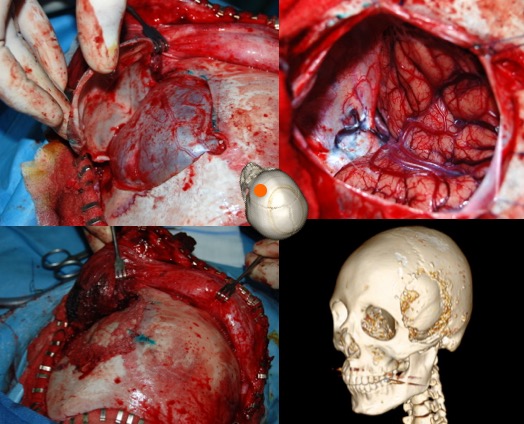 sylviens barber's hump BO