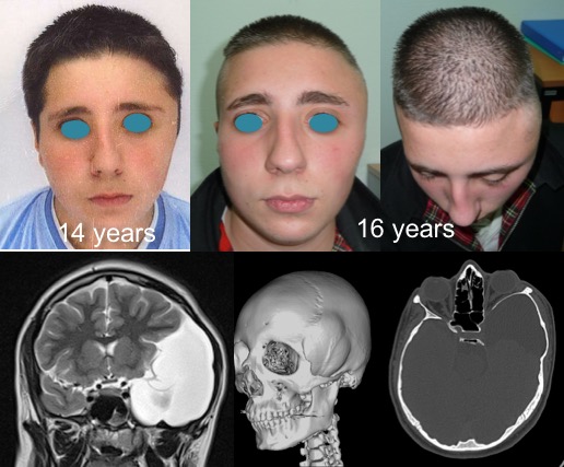 sylviens barber's hump