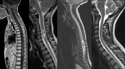 syrinx canal épendymaire