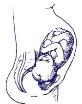 TC obstétr alexander