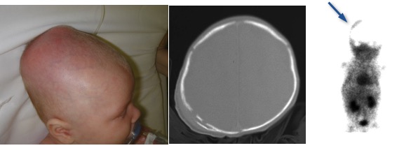 TC obstétr céphalhématome infecté