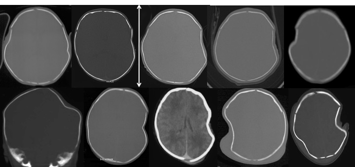 TC obstétr embarrure cutoff