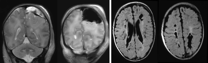TC obstétr HIC anoxie
