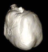 TC obstétr natiforme