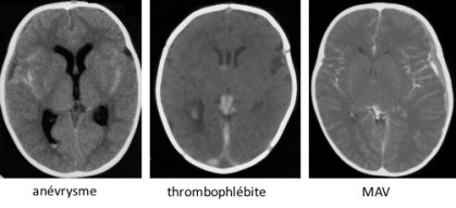 TC SBS causes struct