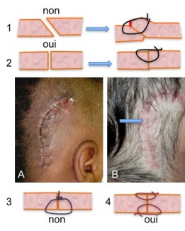 valve incision suture